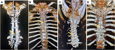 Chronic thoracic pain after cardiac surgery: role of inflammation and biomechanical sternal stability